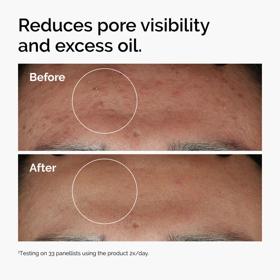 niacinamide-10-zinc-1-b6 ord-niacinamide-zinc-blemish-serum-before-after-pores.jpg