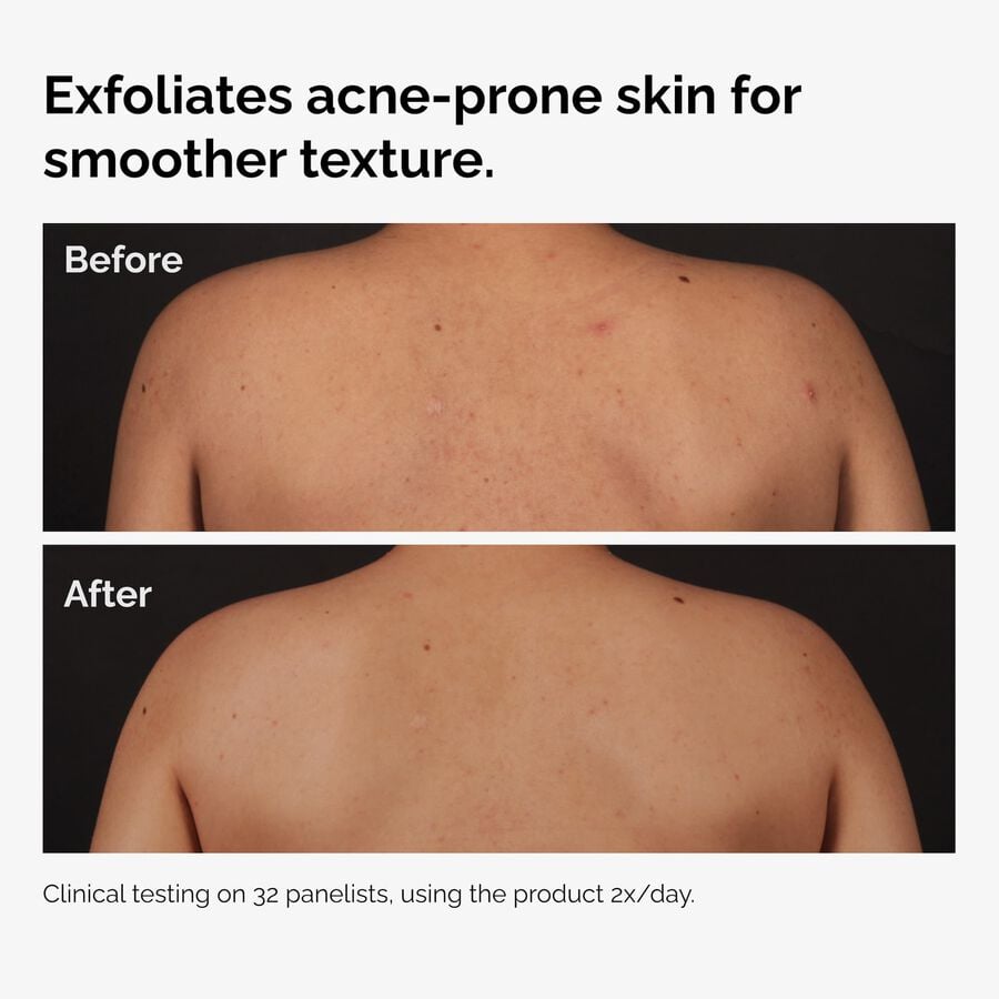 the-body-care-collection-z7 ord-salicylic-acid-body-serum-before-after-graphic-NA.jpg