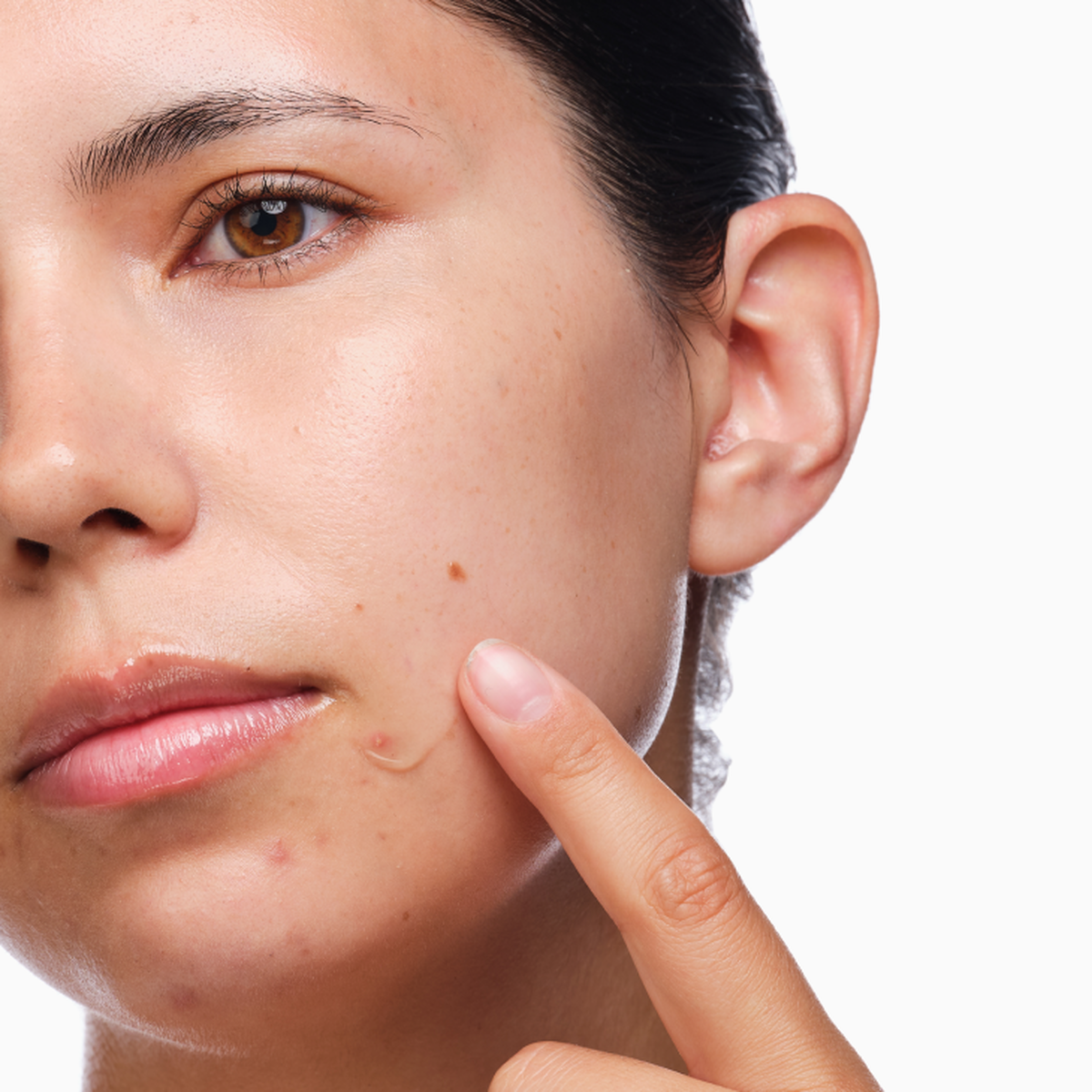 the-acne-set-j5 rdn-the-acne-set-application.png